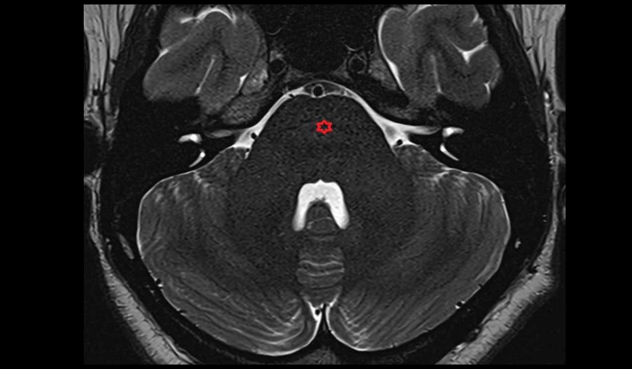 Pons mri 3t axial image