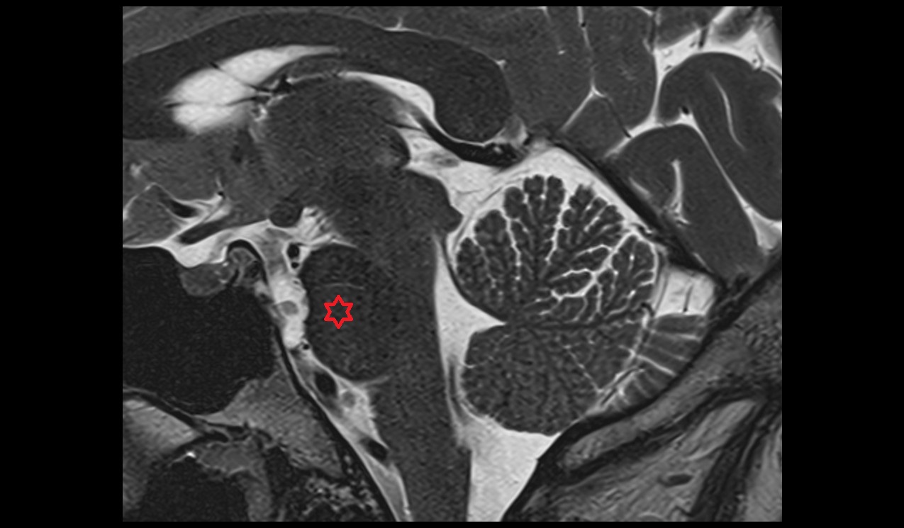 Pons mri 3t sagittal image