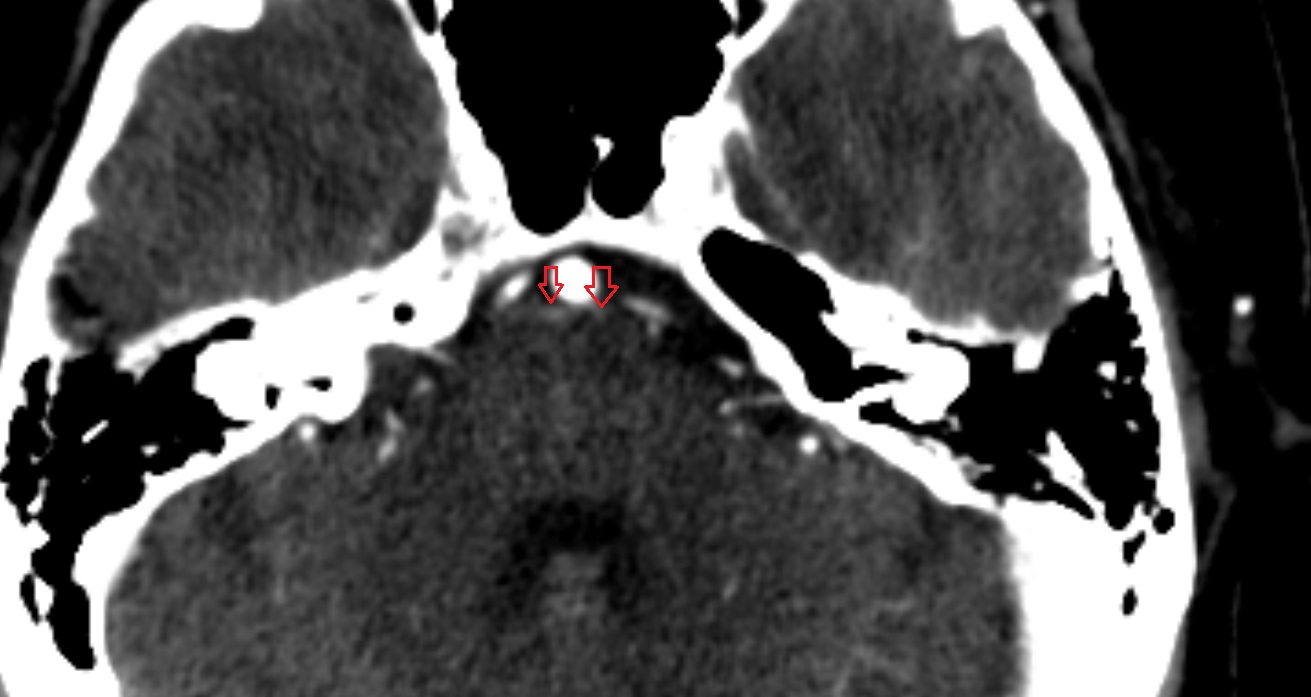 Pontine arteries CT axial anatomy image -img-00001-00001