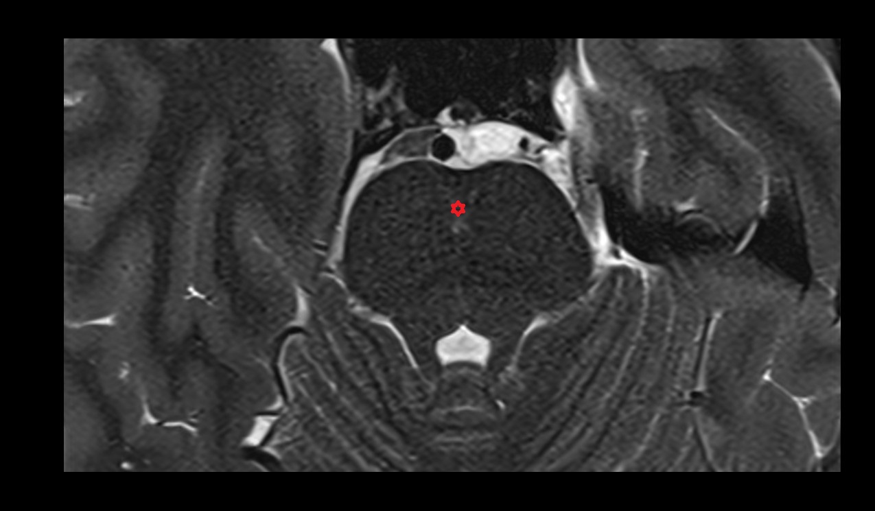 Pontine nucleus mri 3t axial image