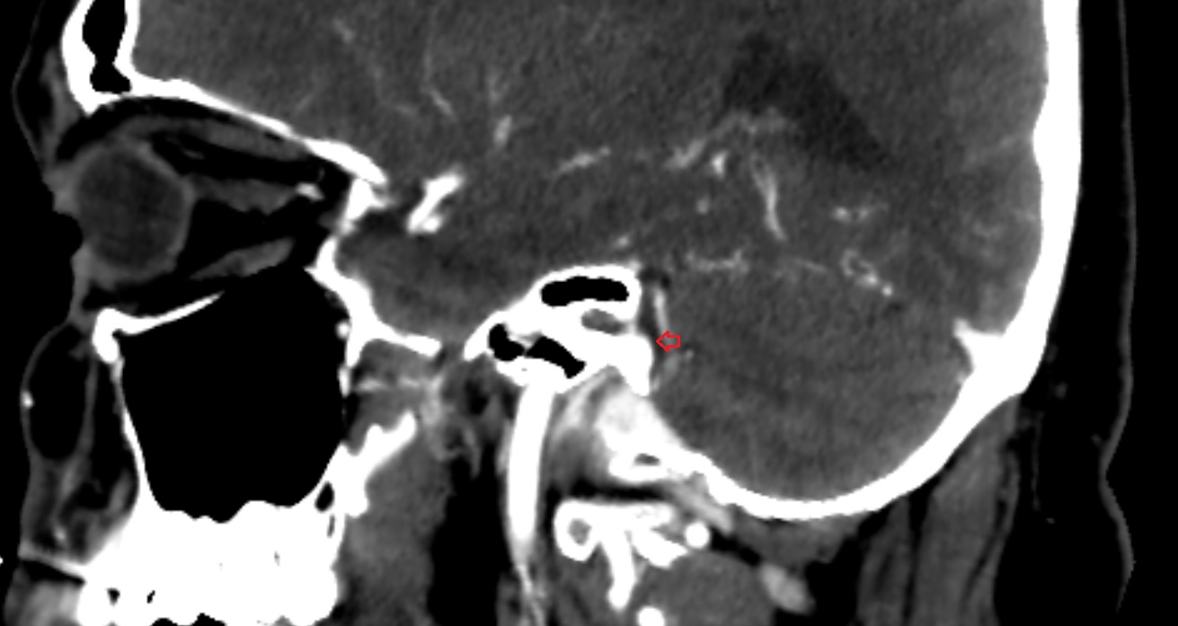 Pontocerebellar cistern  CT sag anatomy image -img-00001-00001