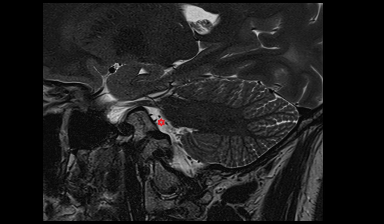 Pontocerebellar cistern (Hilton) mri 3t sagittal image