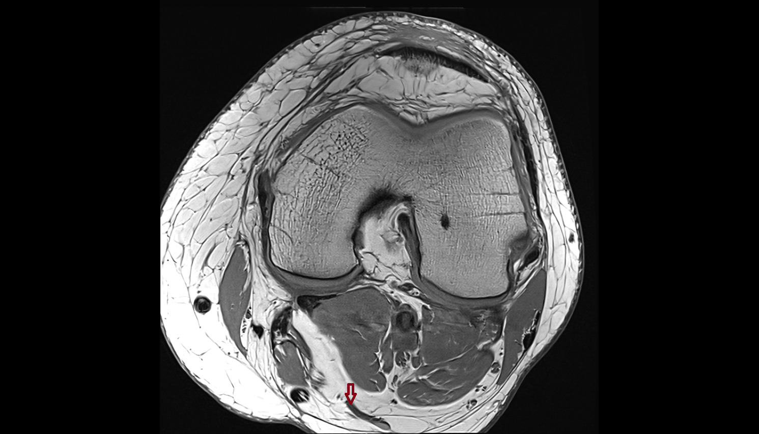 Popliteal_saphenous perforating veins  AXIAL cross sectional anatomy 3T MRI AI enhanced  radiology  anatomy image-img-00000-00000