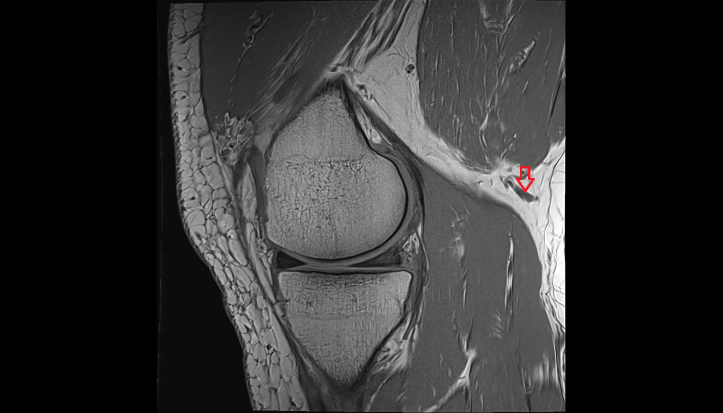 Popliteal_saphenous perforating veins  SAG cross sectional anatomy 3T MRI AI enhanced  radiology  anatomy image-img-00000-00000_00001