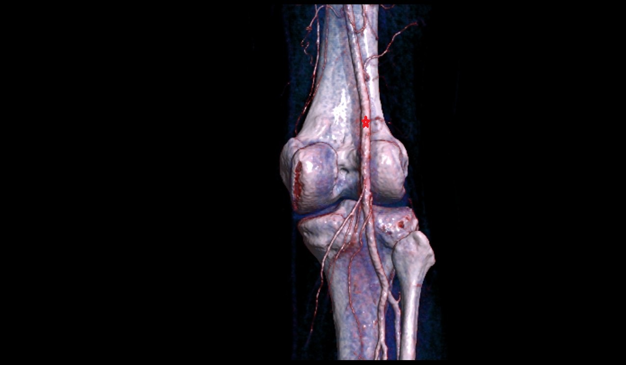 Popliteal artery 3d image
