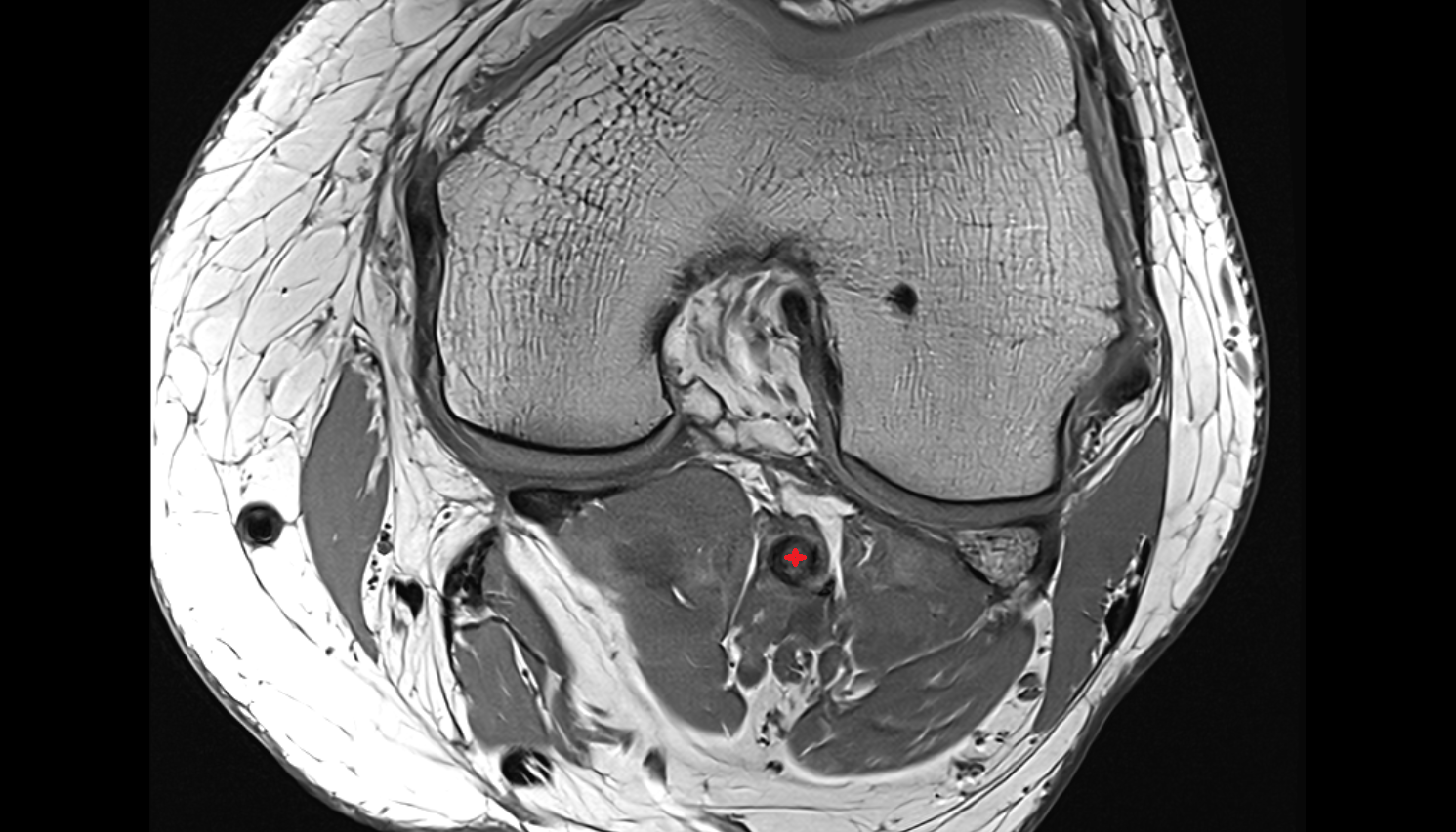 Popliteal artery  axial  cross sectional anatomy 3T MRI AI enhanced  radiology  anatomy image-img-00000-00000