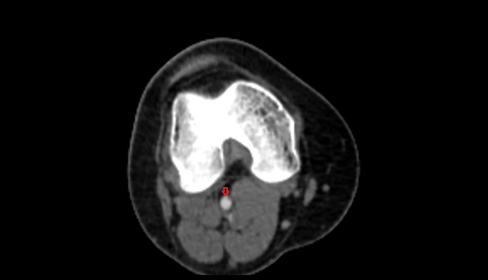 Popliteal artery ct axial image