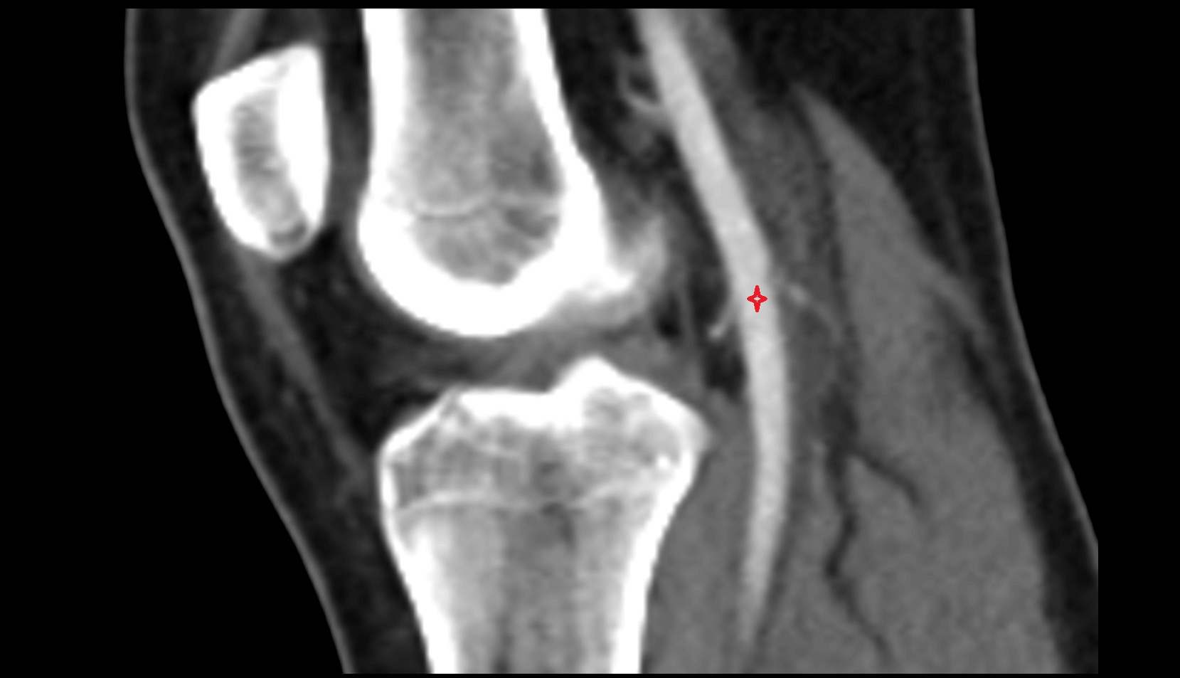 Popliteal artery ct sagittal image