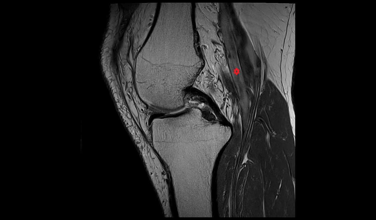 Popliteal artery mri images