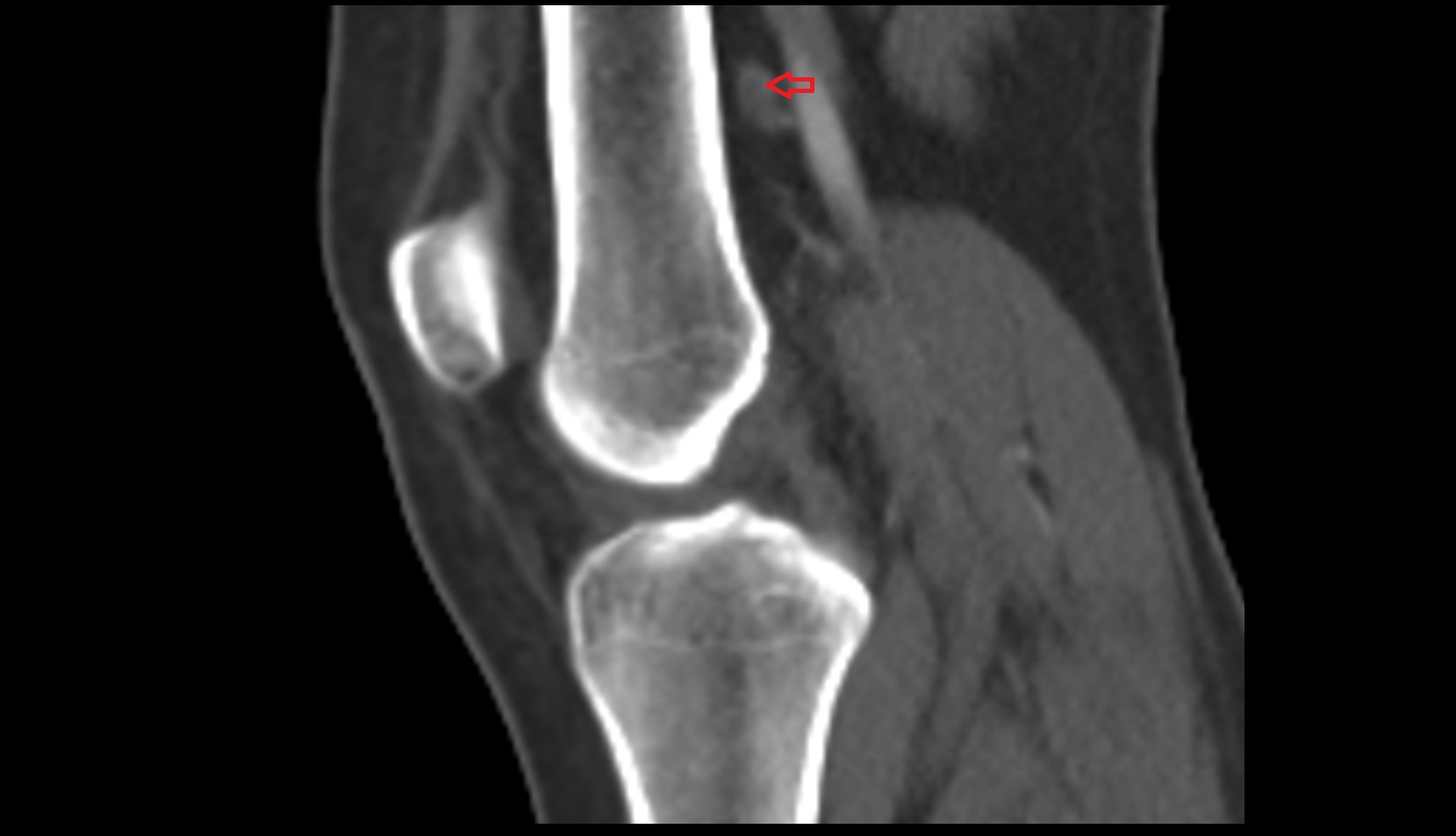 Popliteal lymph nodes CT sagittal image