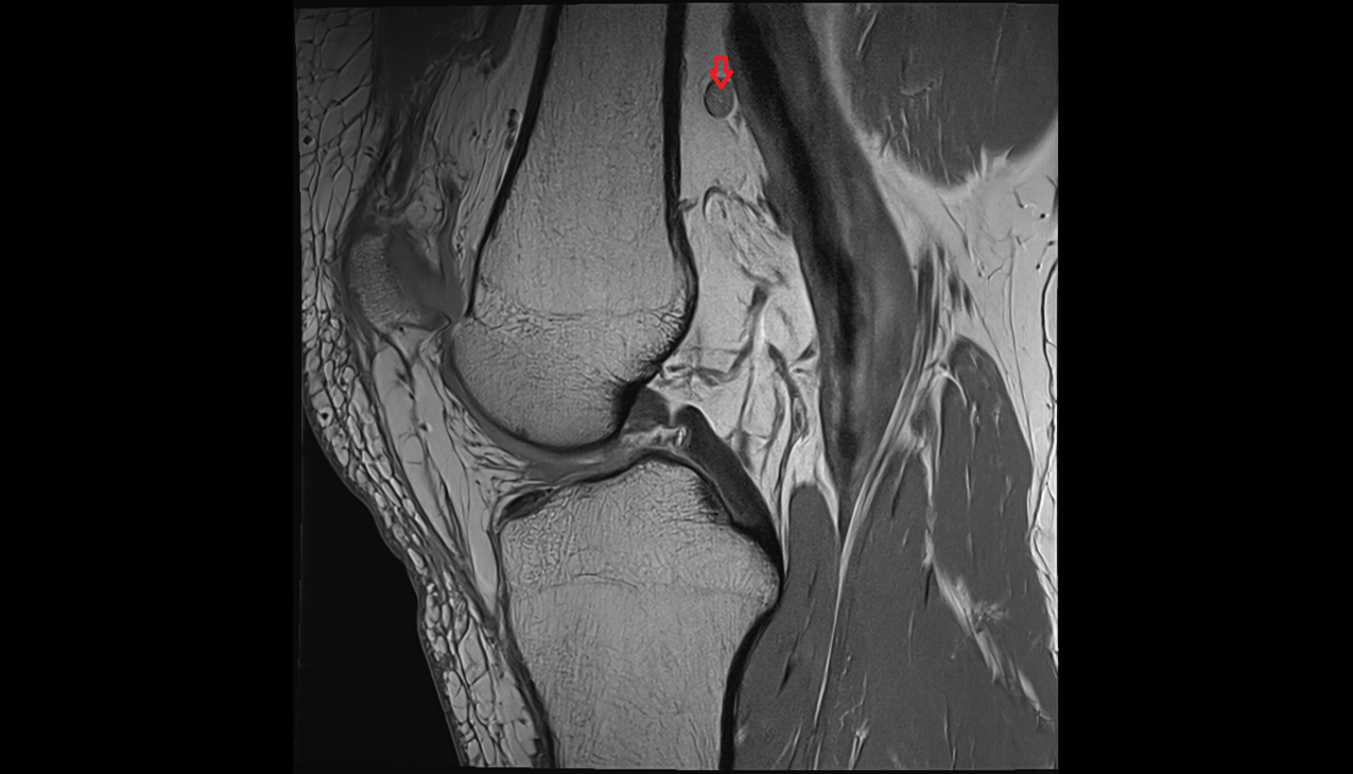 Popliteal lymph nodes SAGITTAL  cross sectional anatomy 3T MRI AI enhanced  radiology  anatomy image-img-00000-00000