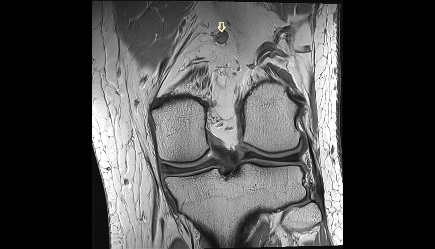 Popliteal lymph nodes coornal  cross sectional anatomy 3T MRI AI enhanced  radiology  anatomy image-img-00000-00000