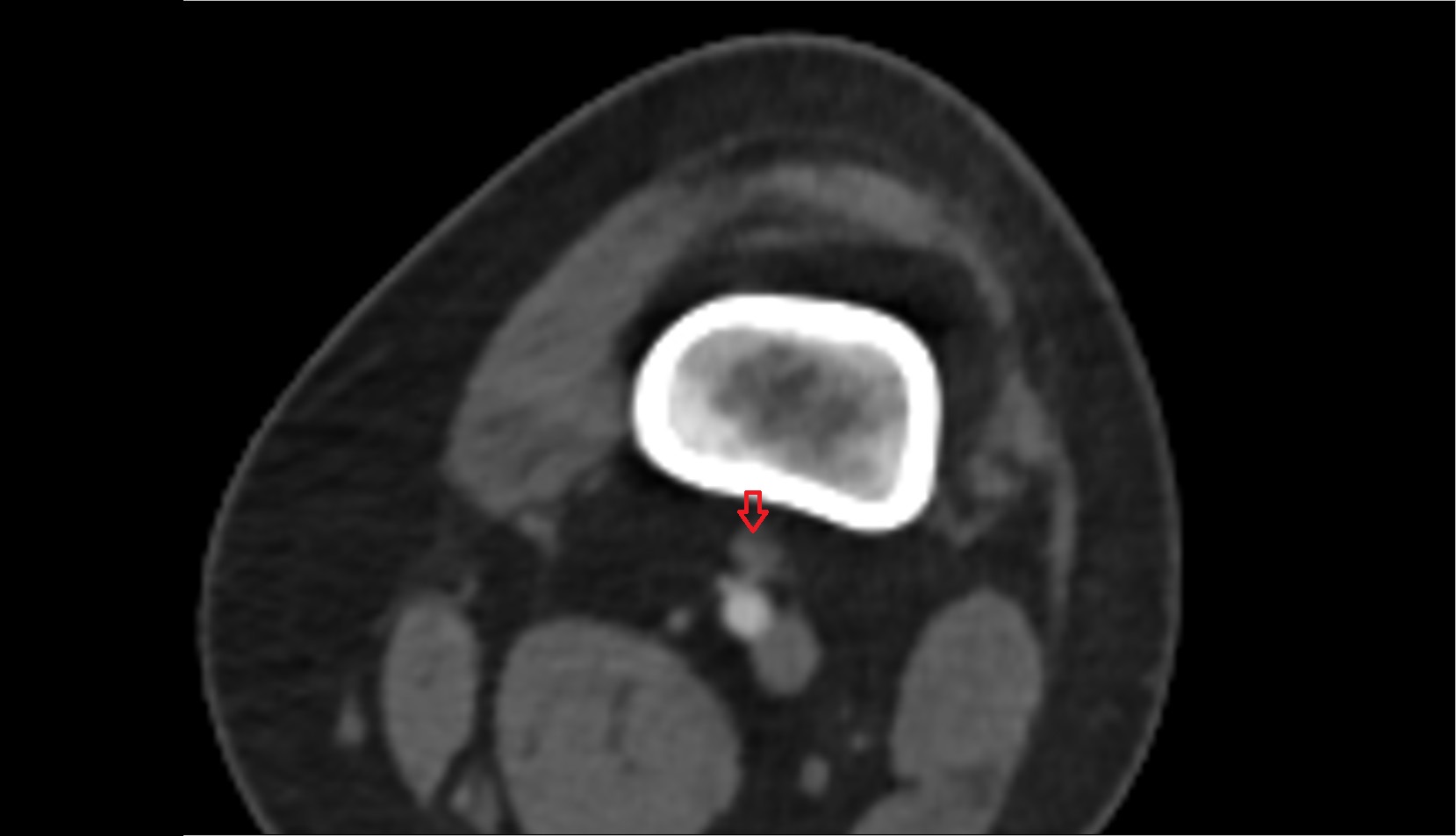 Popliteal lymph nodes ct axial
