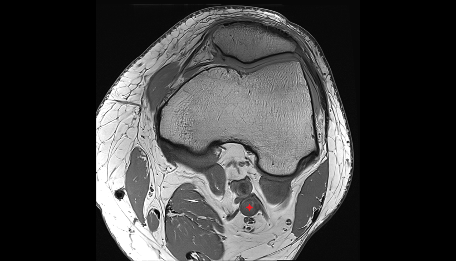 Popliteal vein  MRI axial  cross sectional anatomy 3T MRI AI enhanced  radiology  anatomy image-img-00000-00000