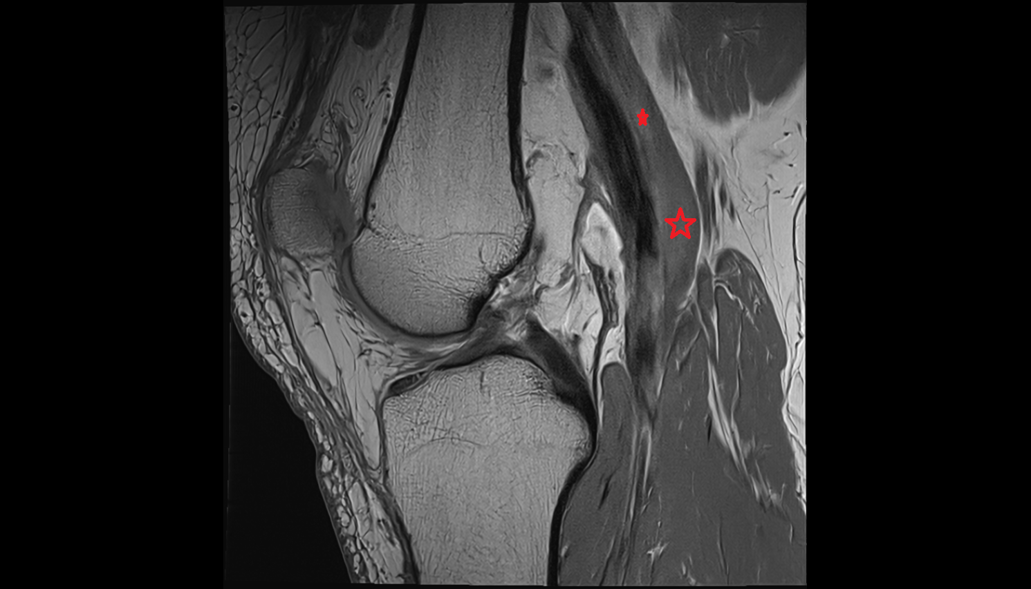 Popliteal vein  MRI sag  cross sectional anatomy 3T MRI AI enhanced  radiology  anatomy image-img-00000-00000