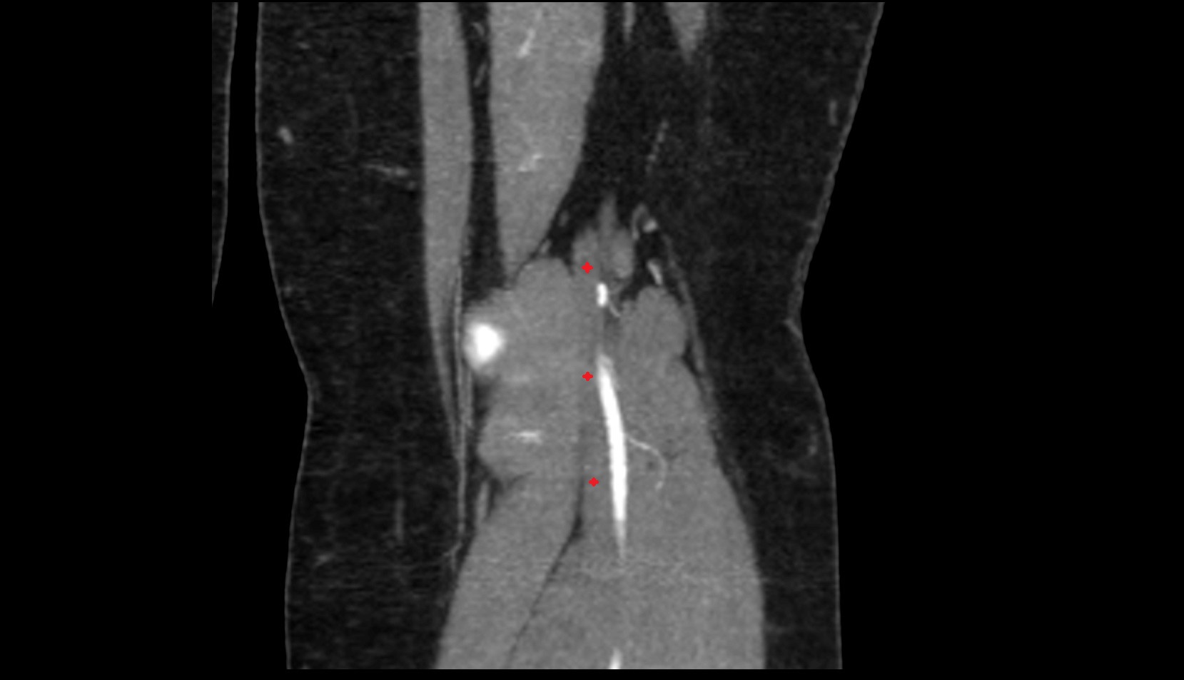 Popliteal vein ct coronal image