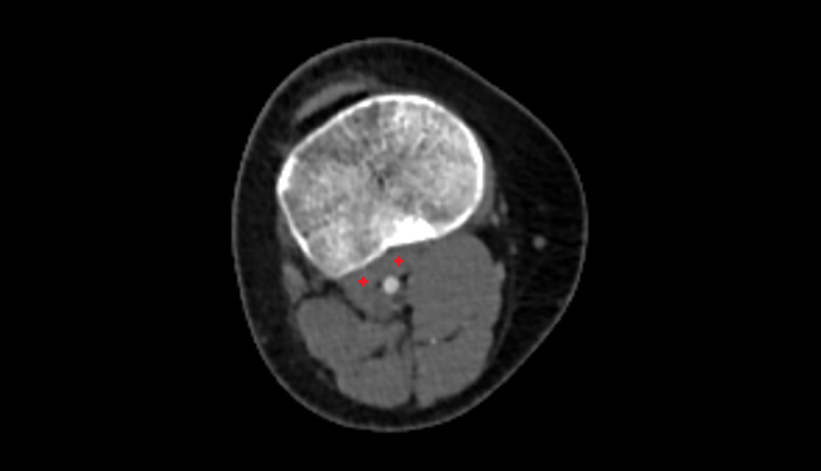 Popliteus muscle ct axial image