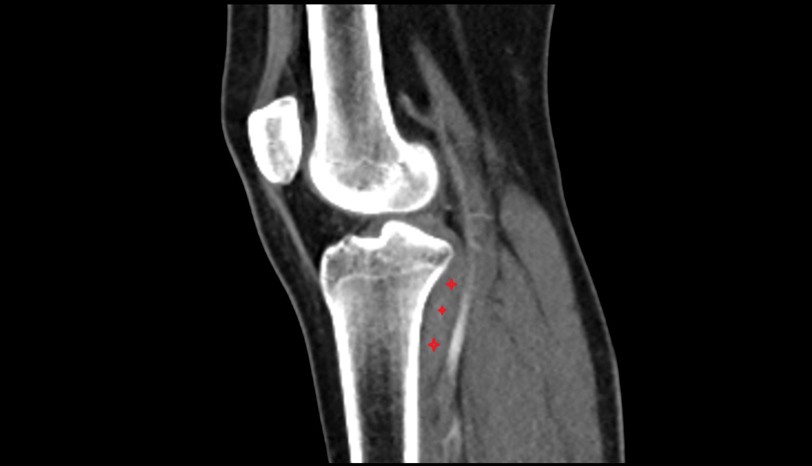 Popliteus muscle ct sagittal image