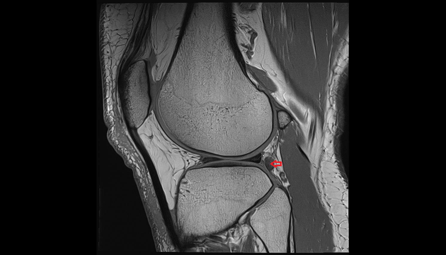 Popliteus tendon sagittal  cross sectional anatomy 3T MRI AI enhanced  radiology  anatomy image-img-00000-00000