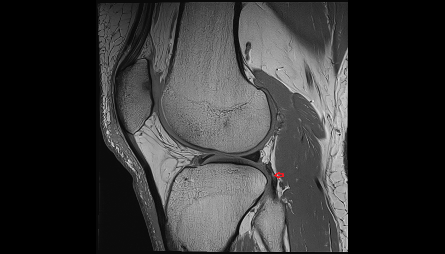 Popliteus tendon sagittal  cross sectional anatomy 3T MRI AI enhanced  radiology  anatomy image-img-00000-00000_00001
