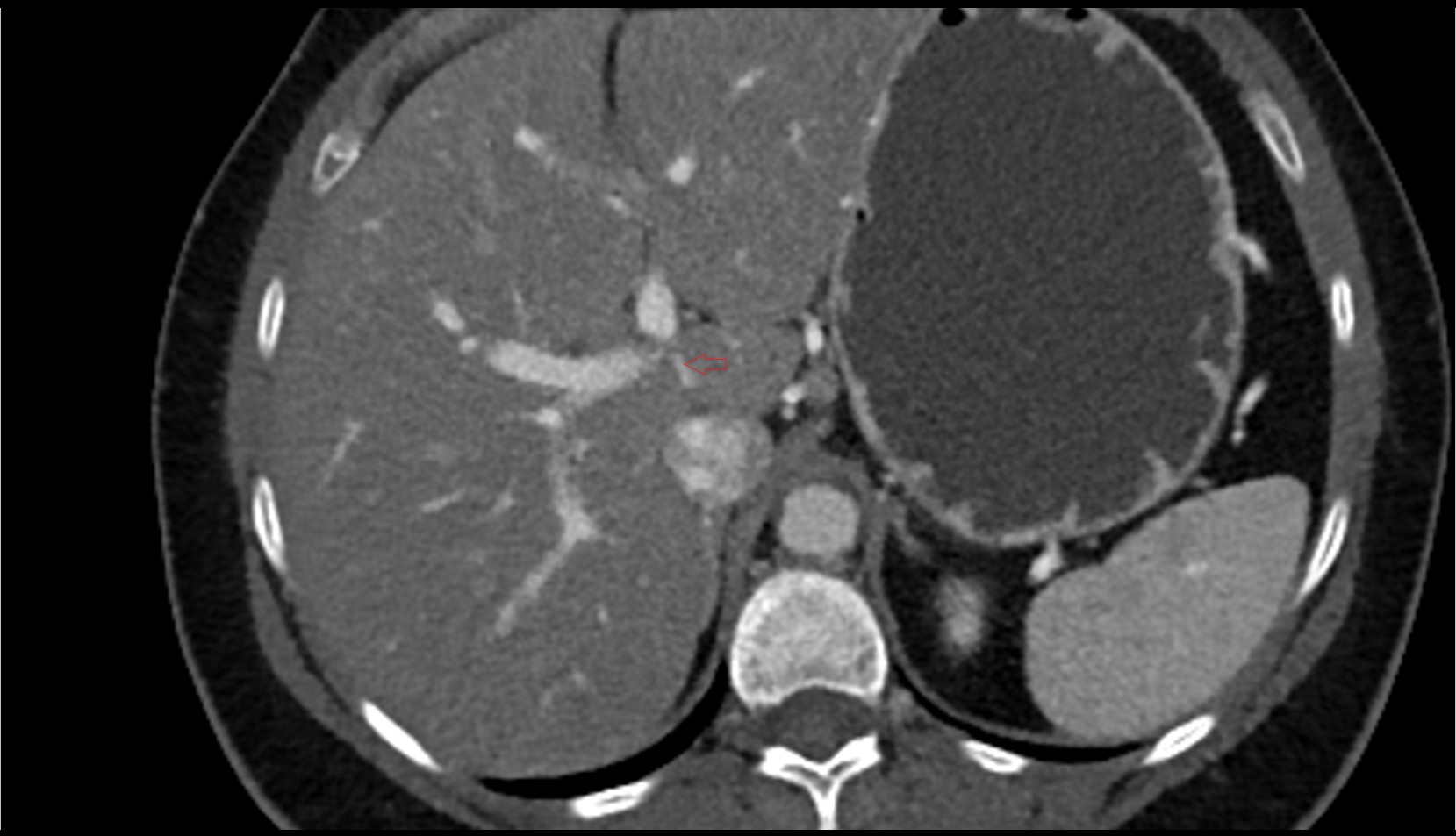 Portal vein branch to liver segment I  CT axial image
