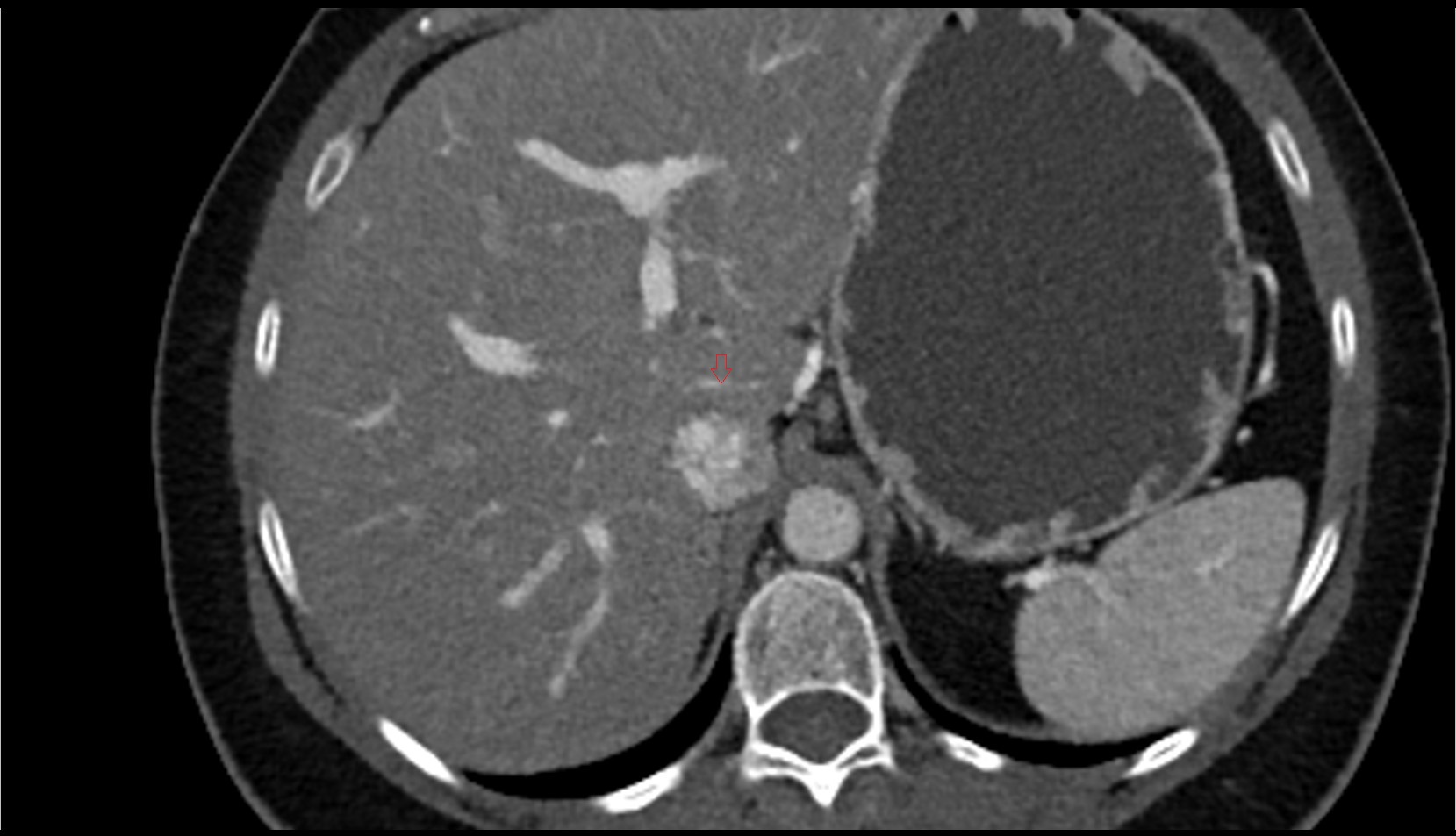 Portal vein branch to liver segment I  CT axial image 1