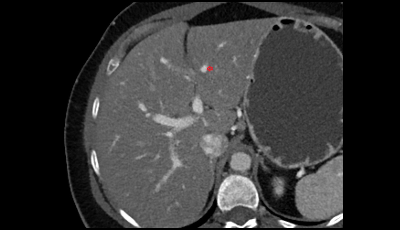Portal vein branch to liver segment III
