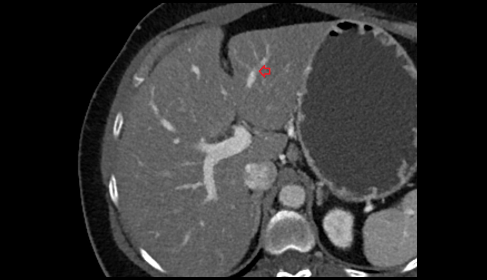 Portal vein branch to liver segment III  axial  CT image