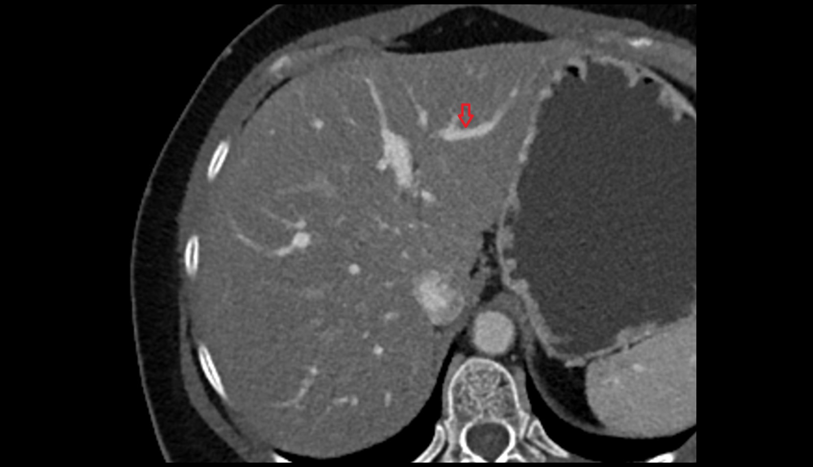 Portal vein branch to liver segment II  axial  CT image