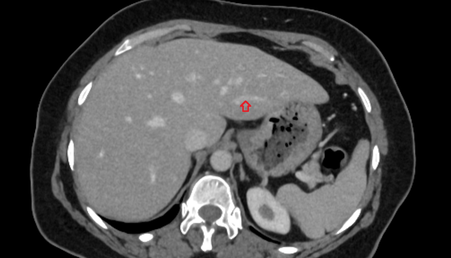 Portal vein branch to liver segment II  axial  anatomy  image -img-00000-00000