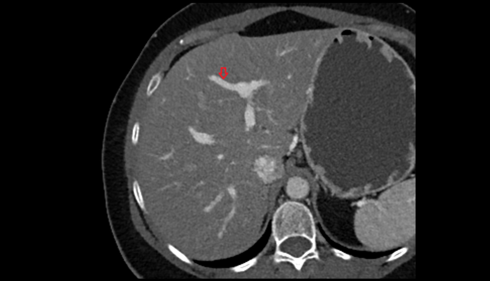 Portal vein branch to liver segment IV CT axial image