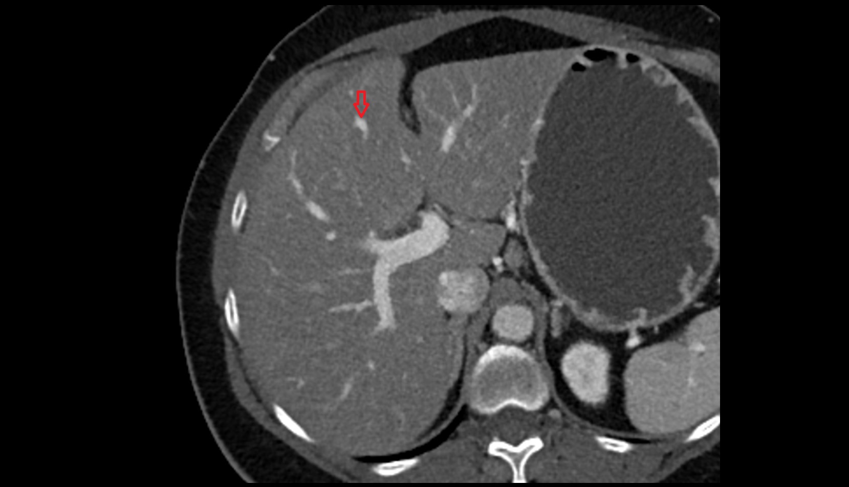 Portal vein branch to liver segment IV CT axial image 1