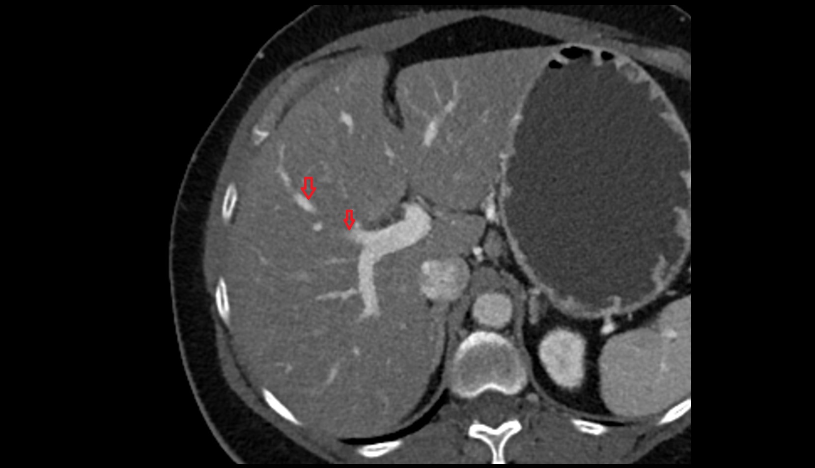 Portal vein branch to liver segment V CT axial image