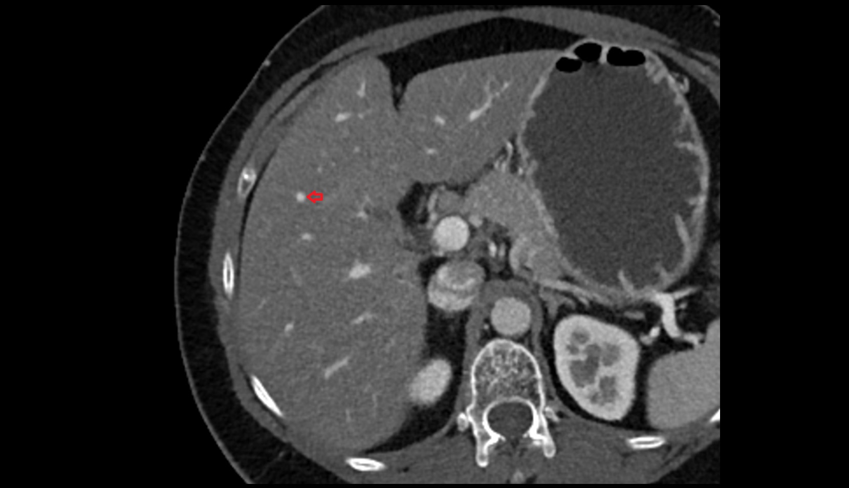 Portal vein branch to liver segment V CT axial image 1
