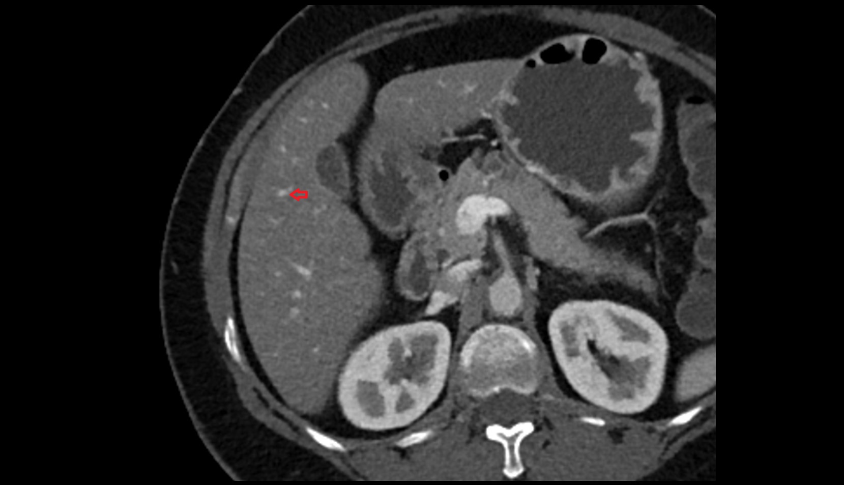 Portal vein branch to liver segment V CT axial image 2
