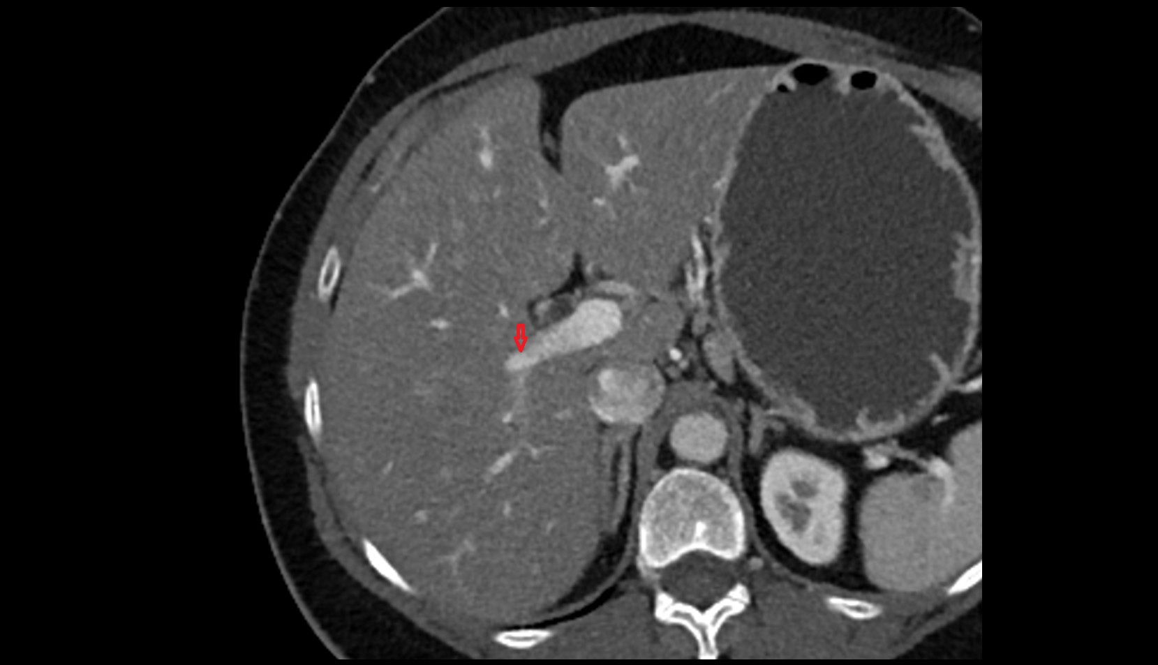 Portal vein branch to liver segment VI CT axial image 0