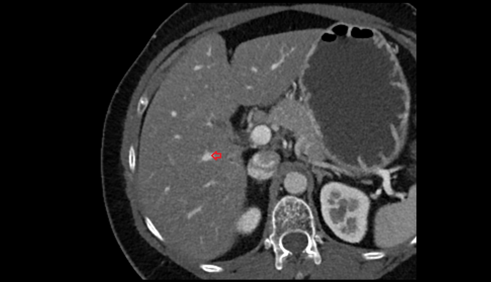 Portal vein branch to liver segment VI CT axial image 1
