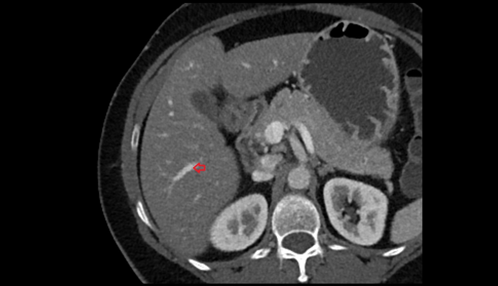 Portal vein branch to liver segment VI CT axial image 2