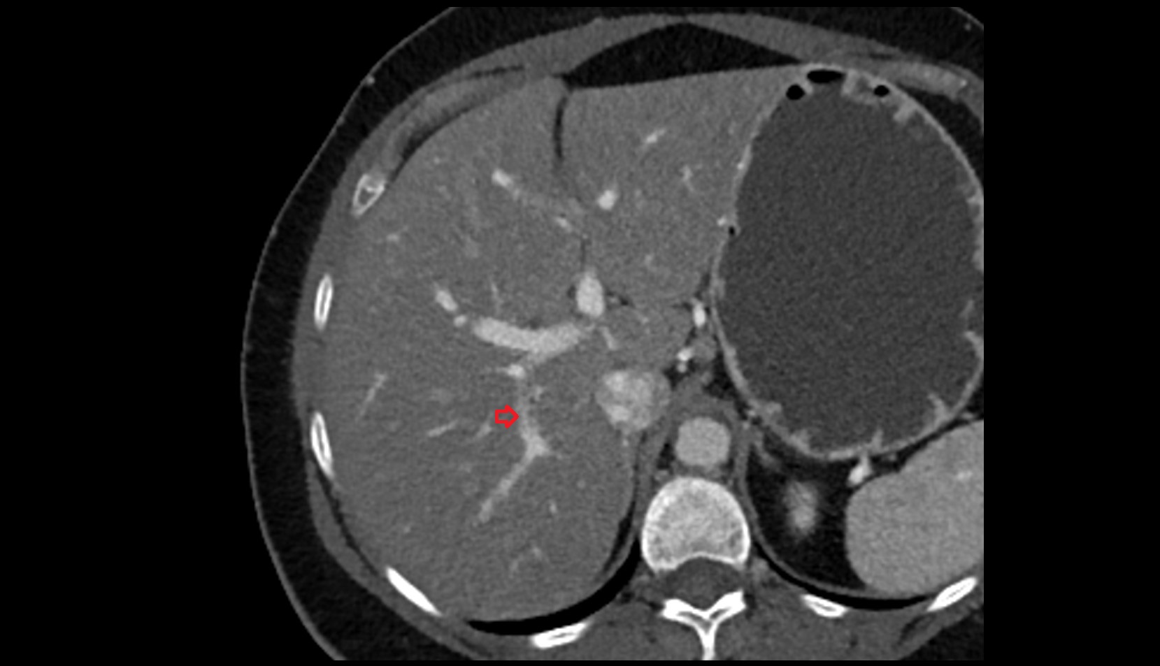 Portal vein branch to liver segment VII CT axial image 0
