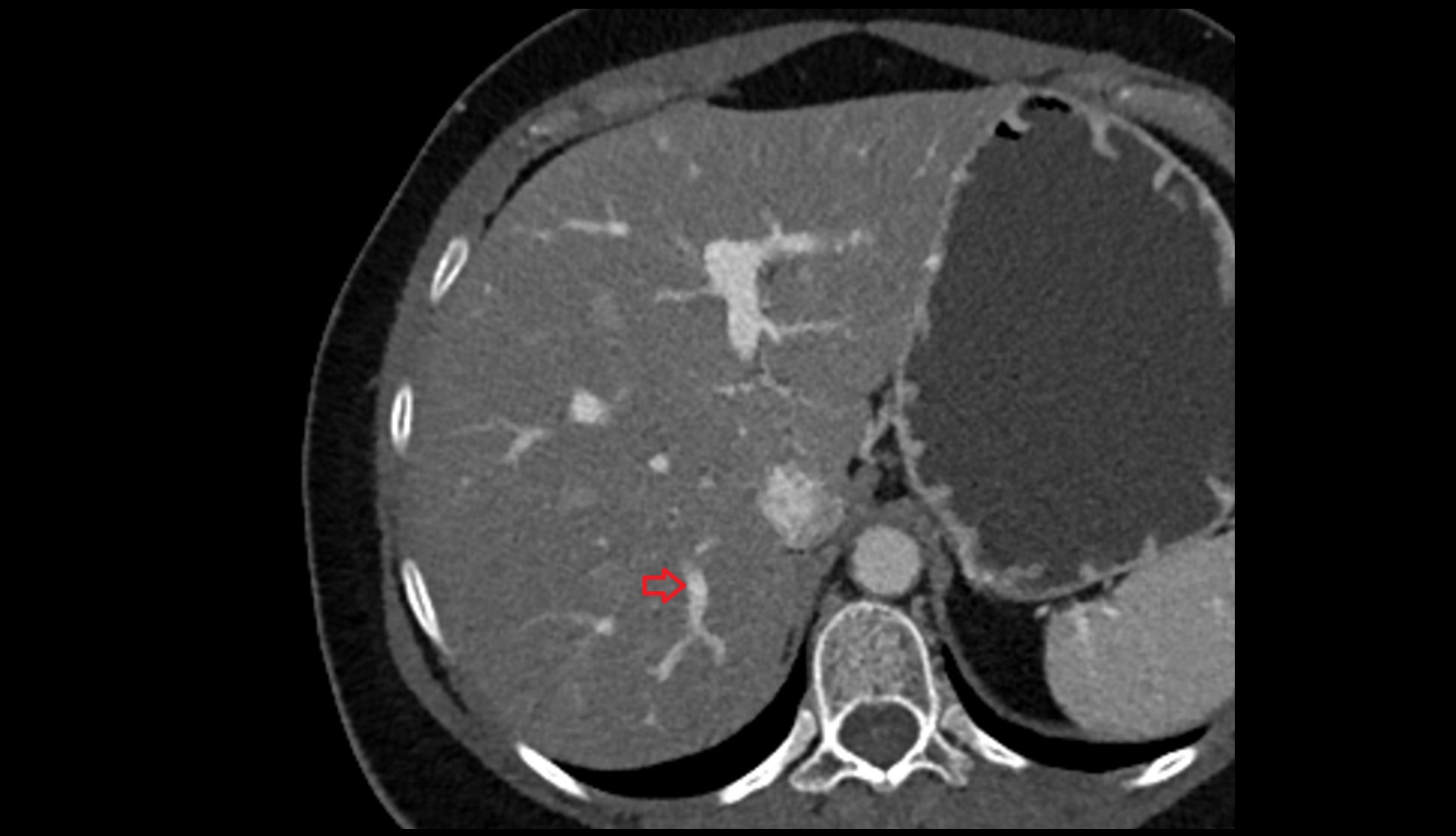 Portal vein branch to liver segment VII CT axial image 1