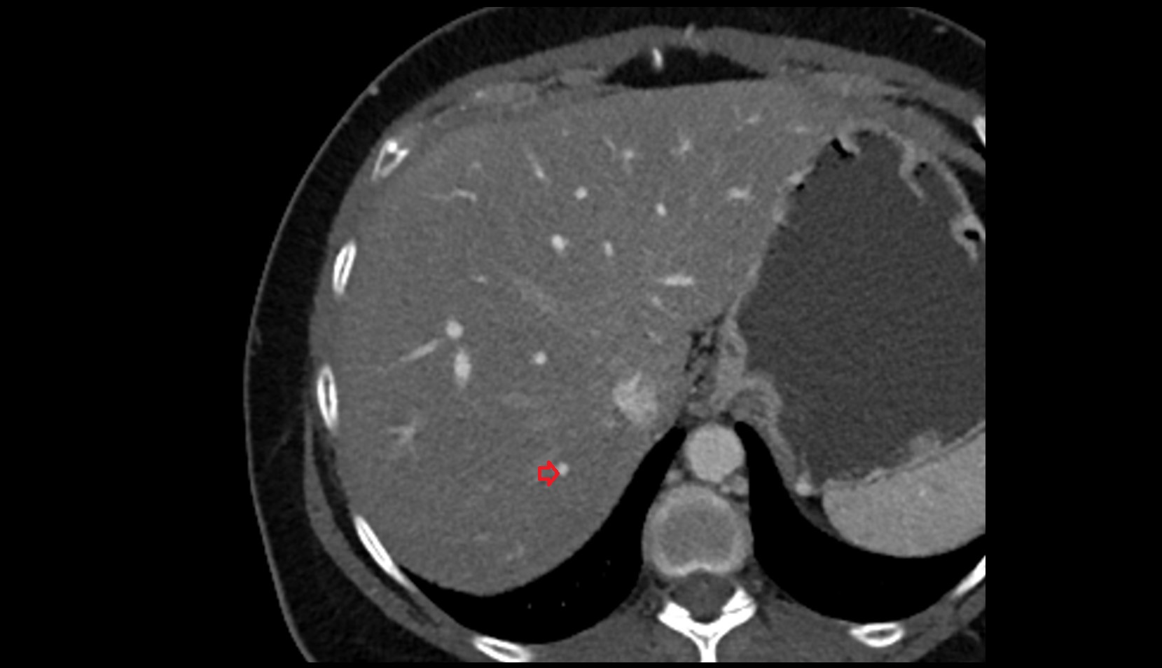 Portal vein branch to liver segment VII CT axial image 2