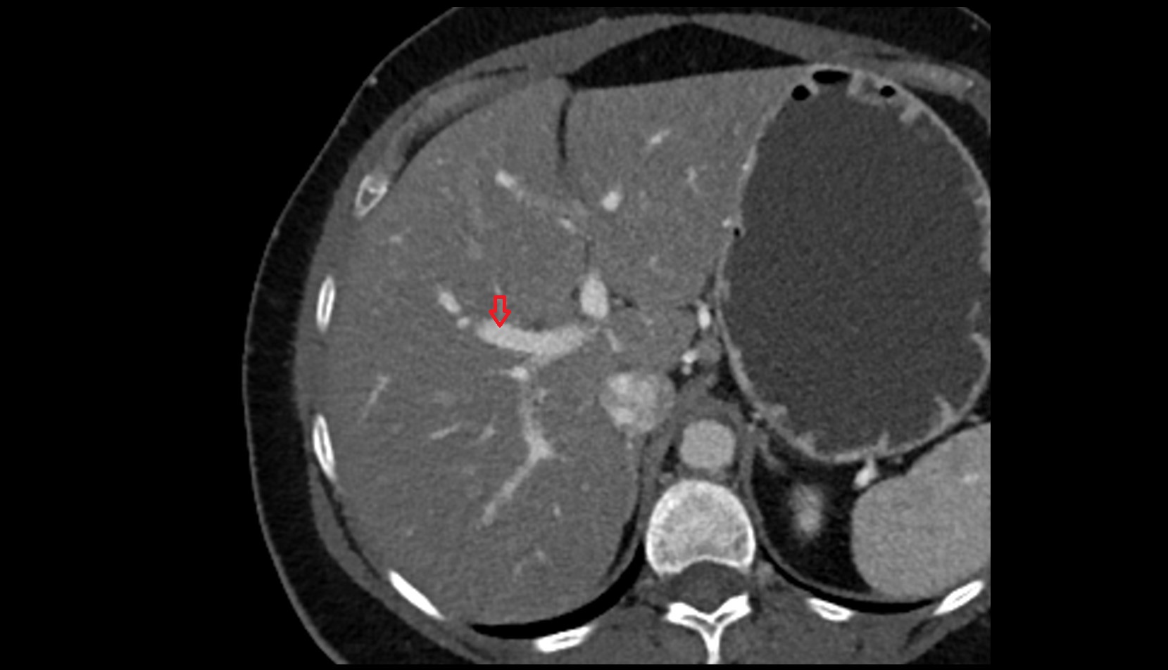 Portal vein branch to liver segment VIII CT axial image 0