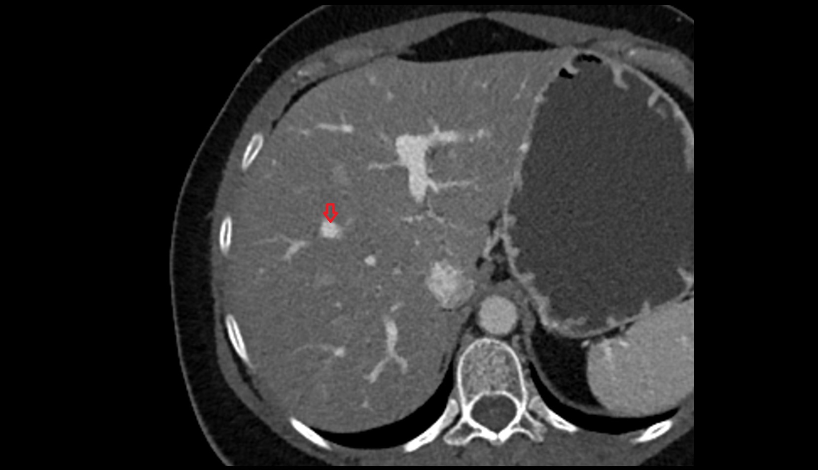 Portal vein branch to liver segment VIII CT axial image 1