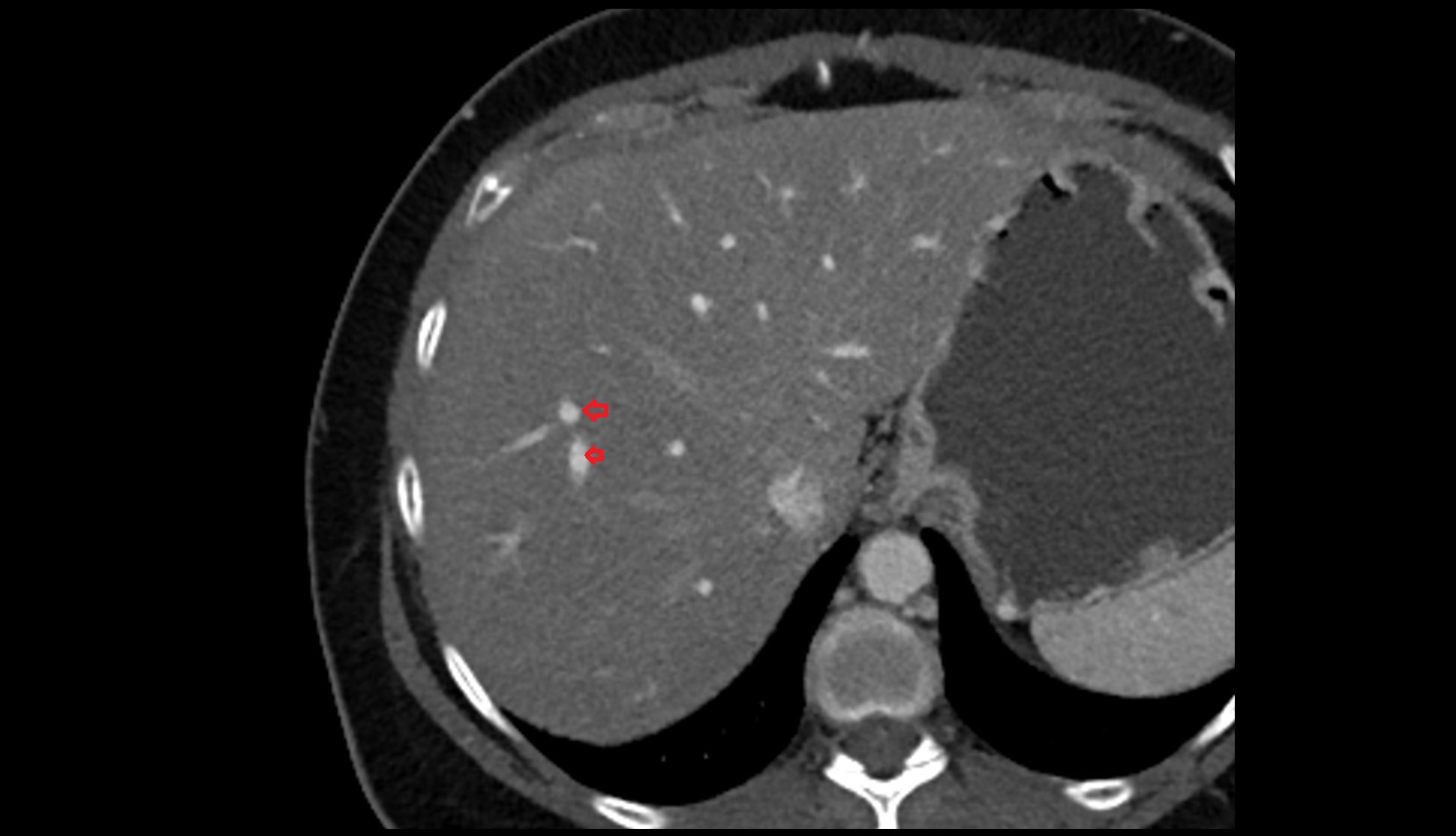 Portal vein branch to liver segment VIII CT axial image 2