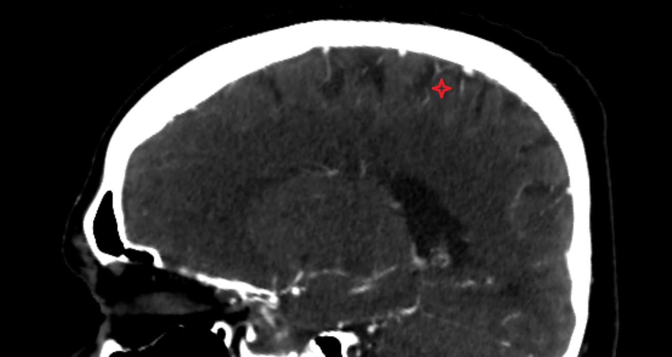 Postcentral gyrus  CT sag anatomy image -img-00001-00001