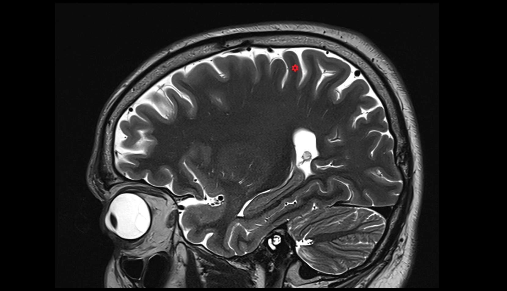 Postcentral gyrus MRI 3T sagittal image