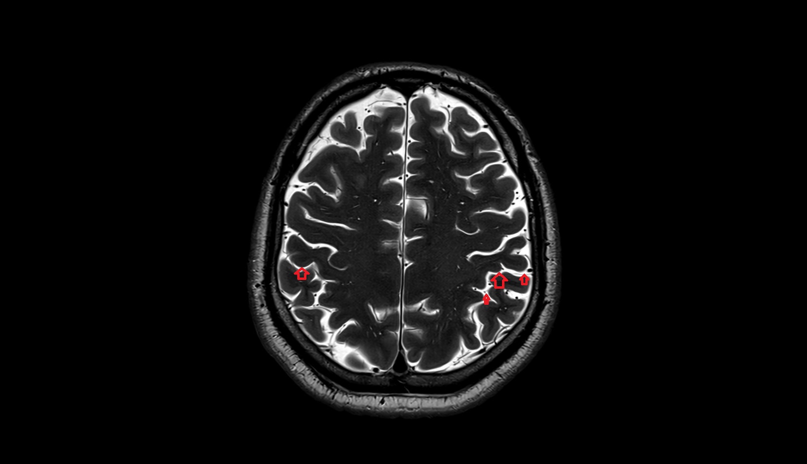 Postcentral sulcus MRI 3T axial image