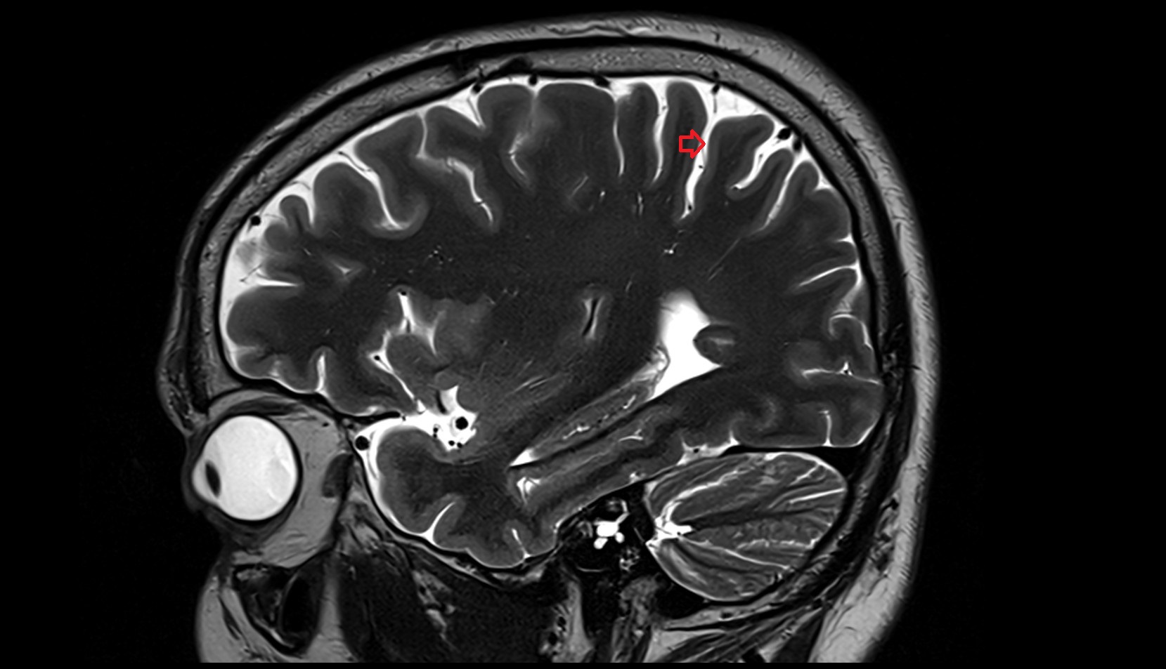 Postcentral sulcus MRI 3Tsagittal image