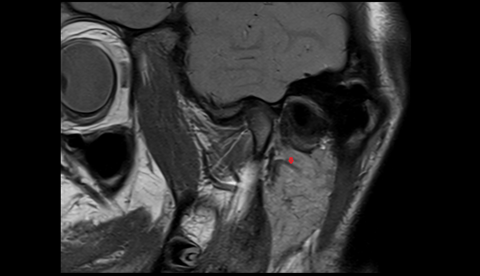 Posterior Auricular Vein MRI images