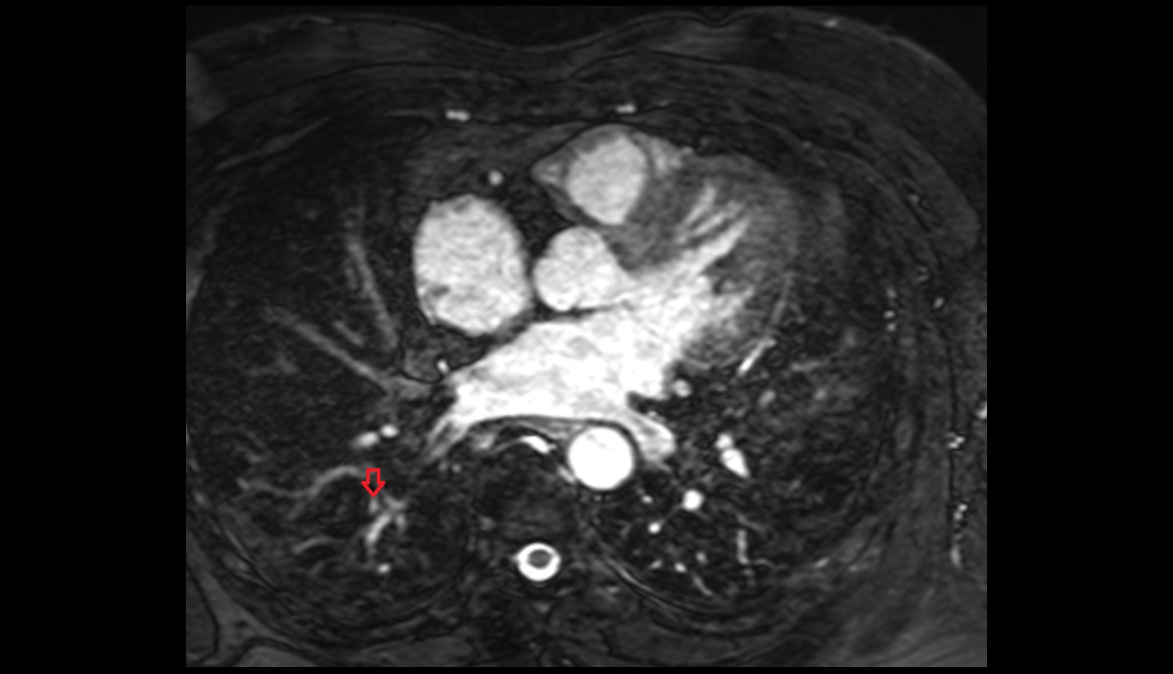 Posterior Basal Segmental Artery of Right Lung mri image
